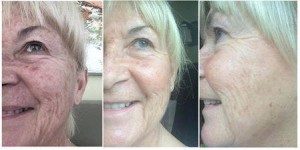 peau-raffermie-beautystrips-fgxpress-300x150